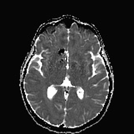 Corpus callosum cavernoma | Image | Radiopaedia.org