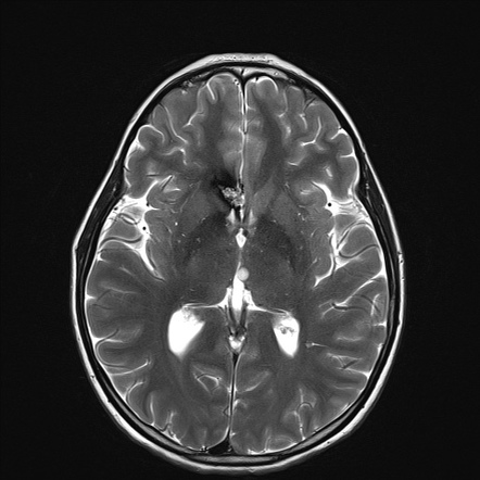 Corpus callosum cavernoma | Radiology Case | Radiopaedia.org