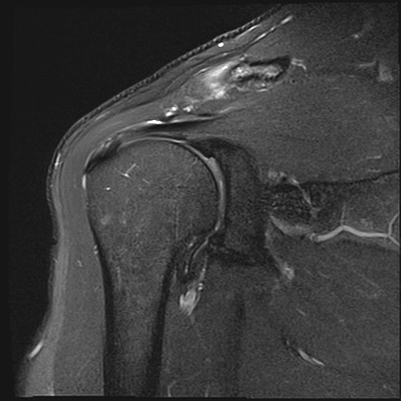 Acromioclavicular joint injury - Rockwood type 2 | Image | Radiopaedia.org