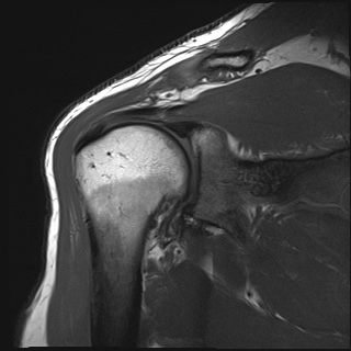 Acromioclavicular joint injury - Rockwood type 2 | Image | Radiopaedia.org