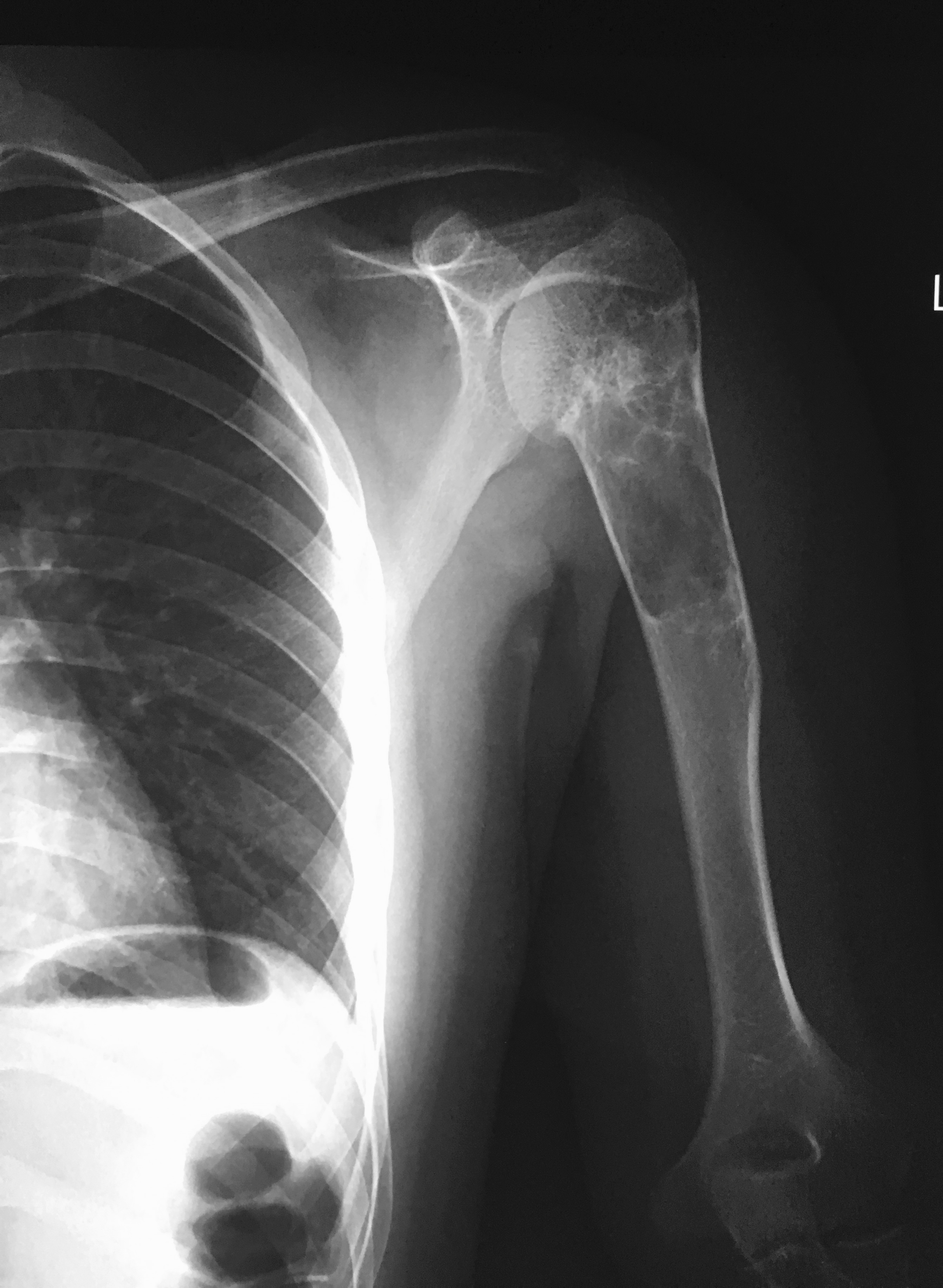 Unicameral Bone Cyst With Pathological Fracture Image