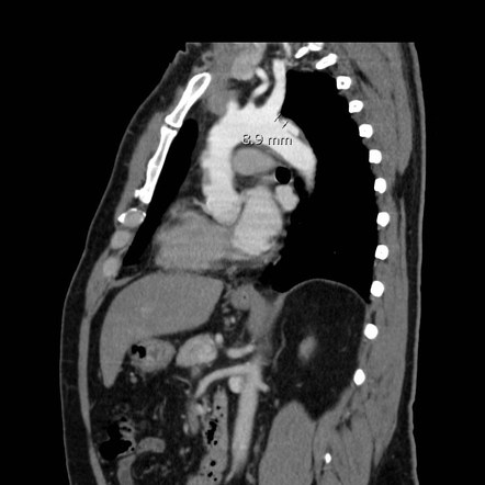 Playlist 'Acute Aortic Syndrome' by Dr Jonathan Bong