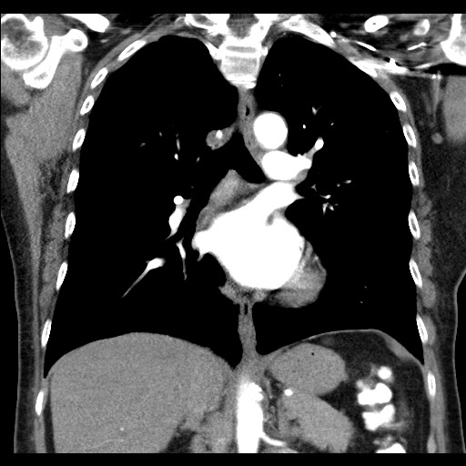 Amyloidosis - bronchial and diffuse nodular pulmonary involvement ...