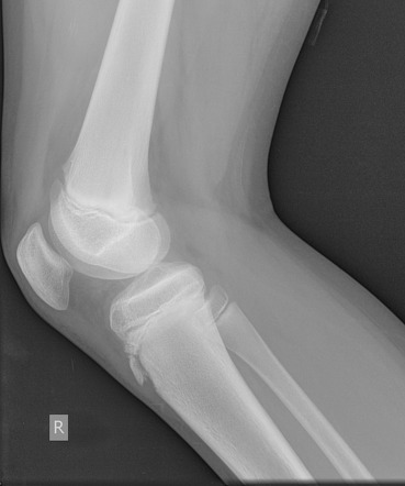 Osgood-Schlatter disease - bilateral | Image | Radiopaedia.org