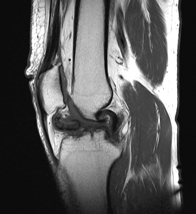 Cyclops lesion with chronic anterior cruciate ligament tear | Image ...