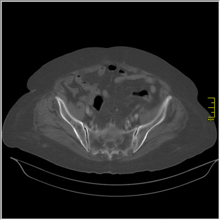 Ingested chicken bone in colon | Radiology Case | Radiopaedia.org