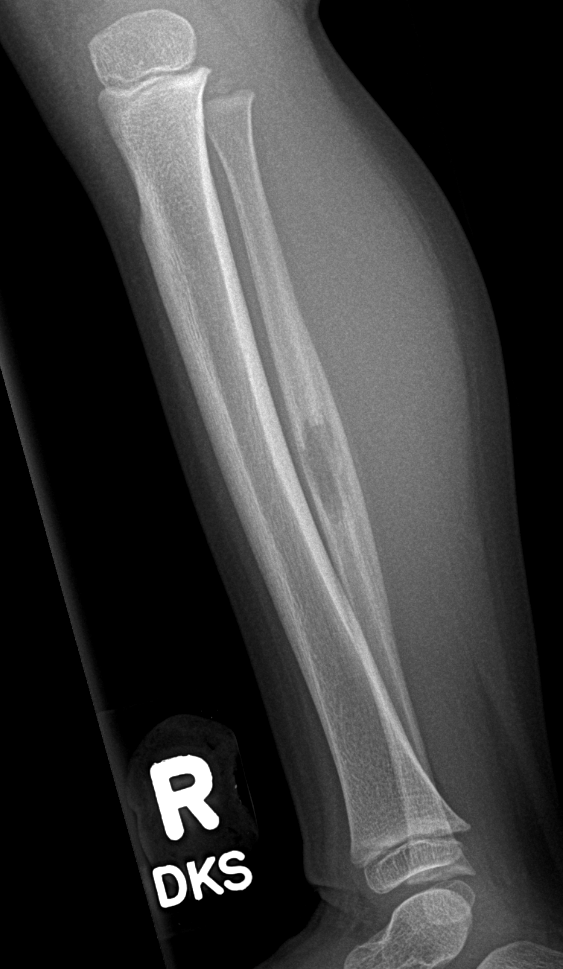 Langerhans Cell Histiocytosis Of Fibula 