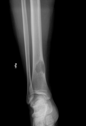 Non-ossifying fibroma | Radiology Case | Radiopaedia.org