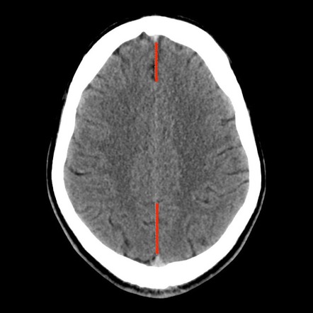 Interhemispheric Fissure Radiology Reference Article Radiopaedia Org