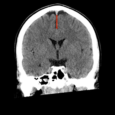 Interhemispheric fissure | Radiology Reference Article | Radiopaedia.org