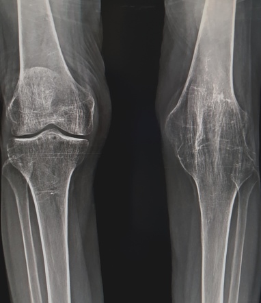 Ankylosis of the knee joint | Radiology Case | Radiopaedia.org