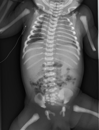 Autosomal recessive infantile osteopetrosis | Radiology Case ...