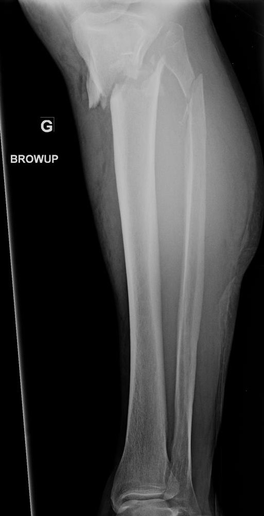 Complex Proximal Tibial And Fibular Fractures | Image | Radiopaedia.org