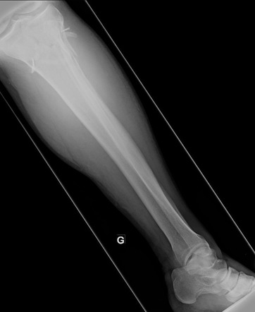 Complex proximal tibial and fibular fractures | Image | Radiopaedia.org