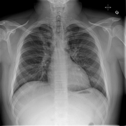 Spontaneous pneumomediastinum | Image | Radiopaedia.org