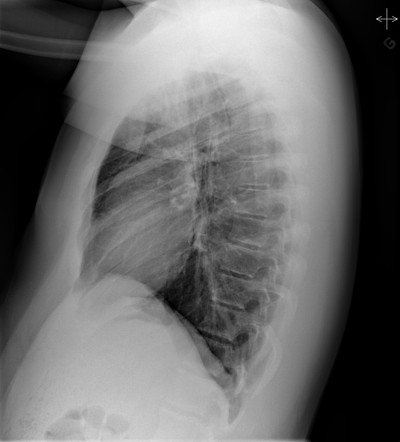 Spontaneous pneumomediastinum | Image | Radiopaedia.org