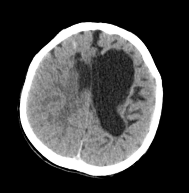 Porencephaly | Radiology Reference Article | Radiopaedia.org