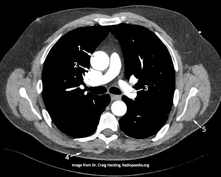 CTA thorax (anatomy quiz) | Radiology Case | Radiopaedia.org