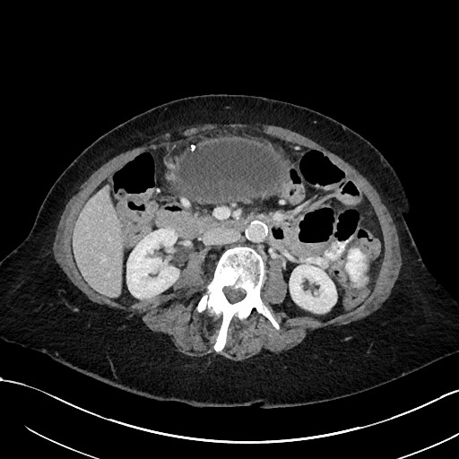 Gastric remnant obstruction due to adenocarcinoma after remote roux-en ...