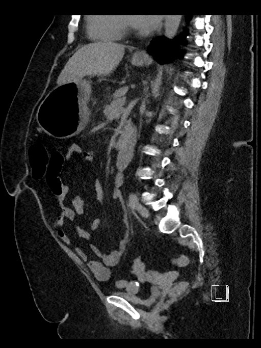 Perforated gastric antral ulcer | Image | Radiopaedia.org