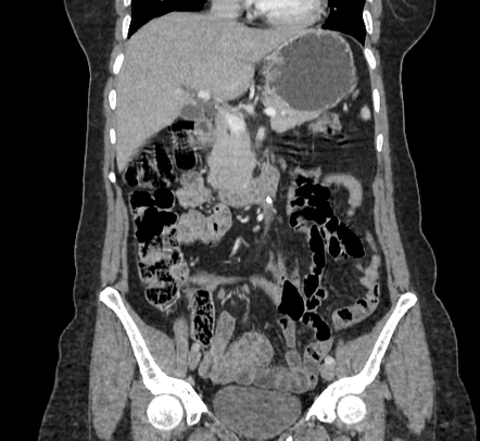 Ampullary tumor | Image | Radiopaedia.org