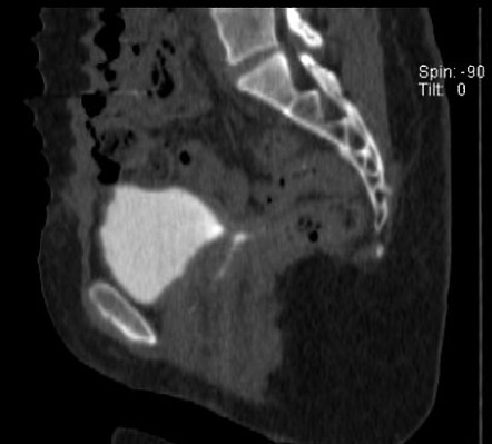 Vesicovaginal fistula | Radiology Case | Radiopaedia.org