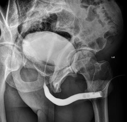 retrograde urethrogram radiology