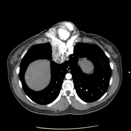 Ectopia cordis | Radiology Case | Radiopaedia.org