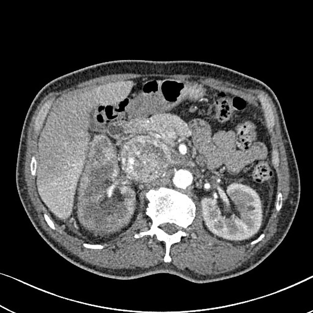 Renal Cell Carcinoma With Inferior Vena Cava Invasion Radiology Case Radiopaedia Org