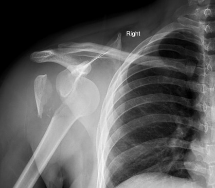 Shoulder dislocation | Radiology Reference Article | Radiopaedia.org