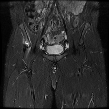 Anterior inferior iliac spine avulsion injury | Radiology Reference ...