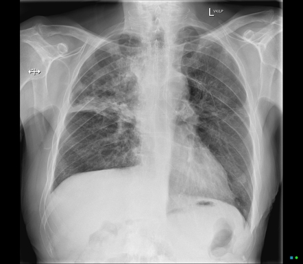 Esophageal and tracheal stents | Radiology Case | Radiopaedia.org