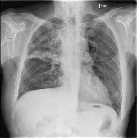 Esophageal and tracheal stents | Radiology Case | Radiopaedia.org