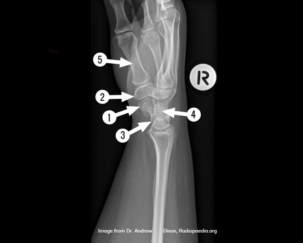 Wrist radiograph (anatomy quiz) | Radiology Case | Radiopaedia.org