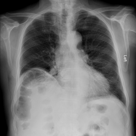 Subphrenic abscess | Radiology Reference Article | Radiopaedia.org