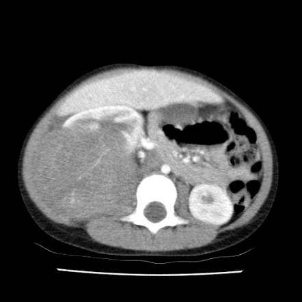 Claw sign (mass) | Radiology Reference Article | Radiopaedia.org