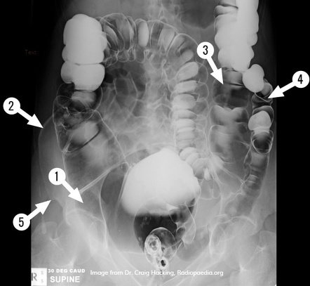 Barium enema (anatomy quiz) | Radiology Case | Radiopaedia.org