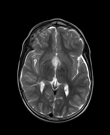 Intracranial hypotension in patient with chiasmatic / hypothalamic ...