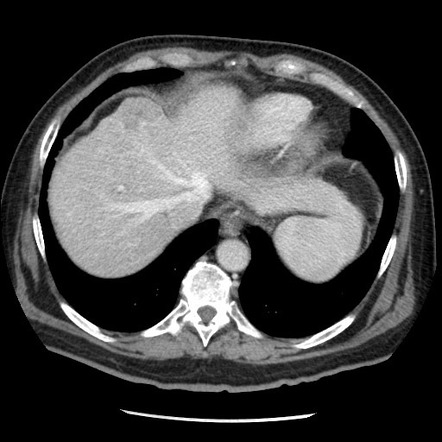 CT triple-phase liver (protocol) | Radiology Reference Article ...