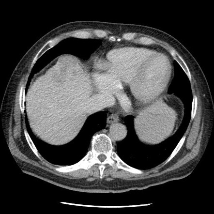 Ct Triple-phase Liver (protocol) 