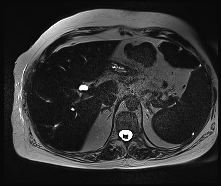 Cholelithiasis And Choledocholithiasis 