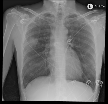 Right upper lobe pneumonia | Radiology Case | Radiopaedia.org