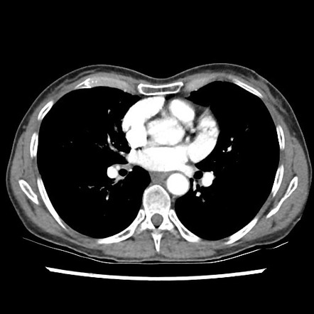 Right upper lobe pneumonia | Image | Radiopaedia.org