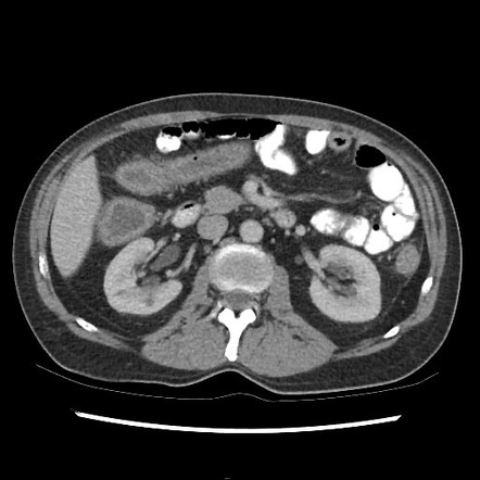 Ulcerative colitis | Radiology Case | Radiopaedia.org