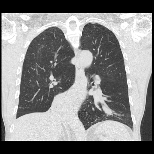 Allergic bronchopulmonary aspergillosis (ABPA) | Image | Radiopaedia.org