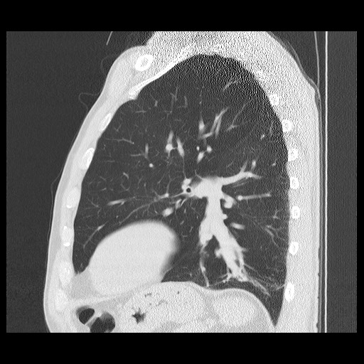 Allergic bronchopulmonary aspergillosis (ABPA) | Image | Radiopaedia.org