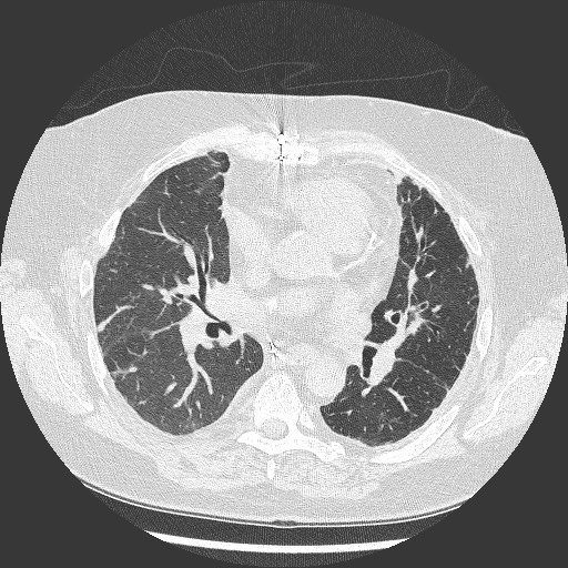 Chronic Lung Allograft Dysfunction - Restrictive Form | Image ...