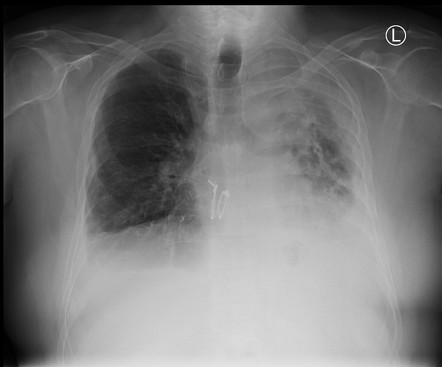 Chronic Lung Allograft Dysfunction | Radiology Reference Article ...