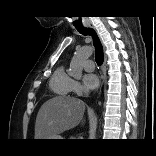 Chronic lung allograft dysfunction - restrictive form | Image ...