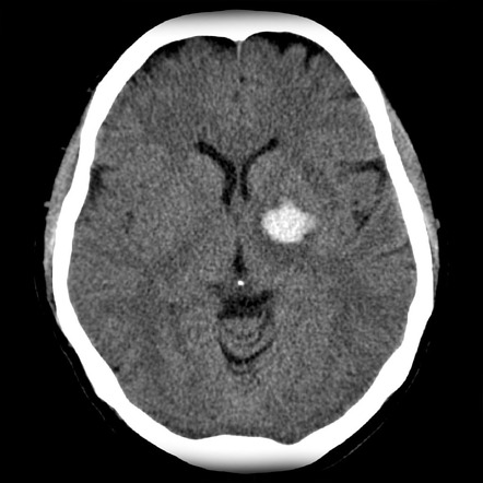 Basal Ganglia Hemorrhage Radiology Reference Article Radiopaedia Org